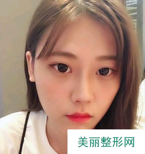 长沙湘雅医院切眼袋案例，短短15天一起来见证一下！