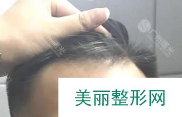 广州曙光植发案例