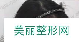 成都新生植发案例