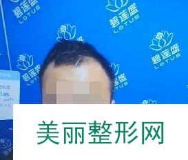 碧莲盛植发靠谱吗