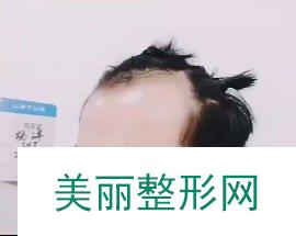 福州碧莲盛植发
