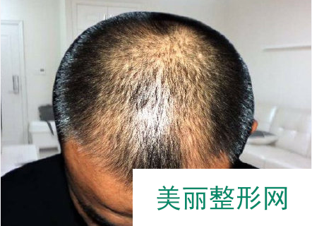 上海同济医院植发