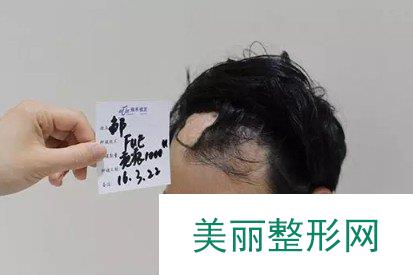 南宁疤痕植发案例