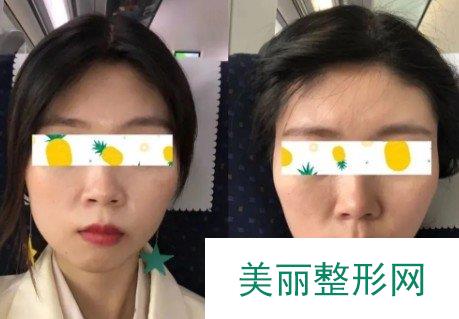 美莱口腔整牙经历