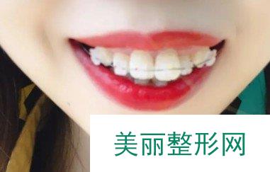 美莱口腔整牙经历
