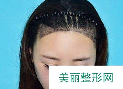 杭州科发源植发医院正规吗