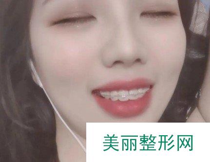 上海圣贝口腔医院牙齿矫正案例