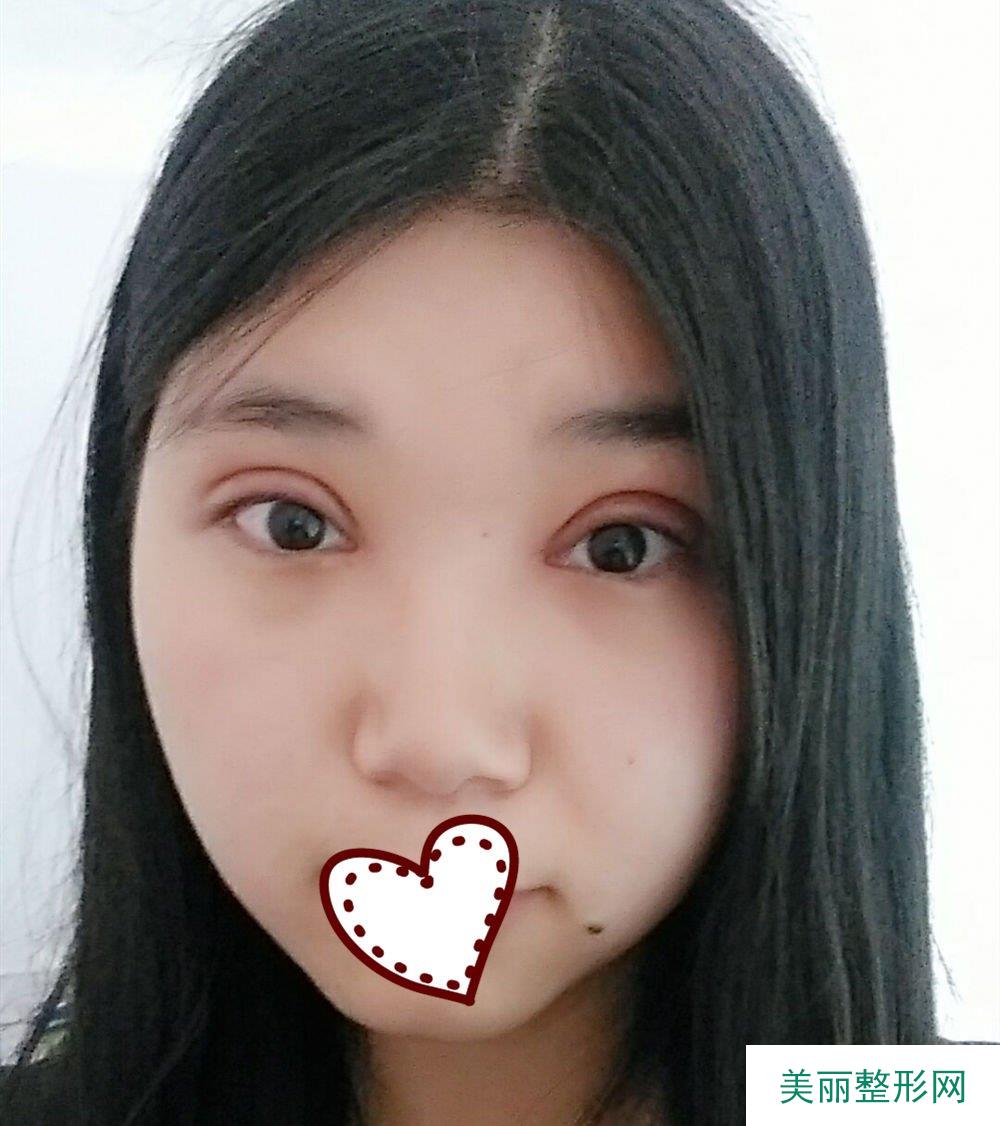 华西医院许学文双眼皮怎么样