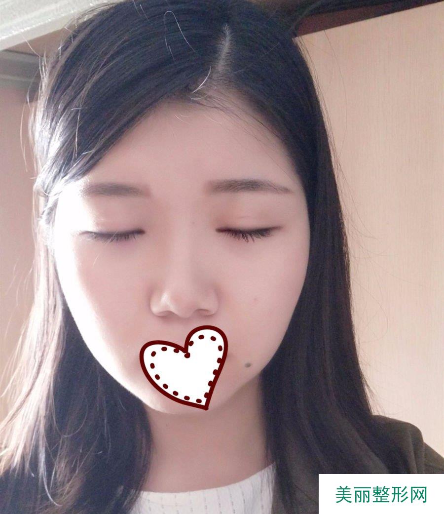 华西医院许学文双眼皮多少钱