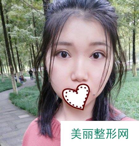 华西医院许学文怎么样 双眼皮多少钱
