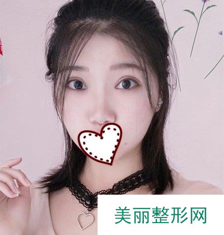 华西医院许学文双眼皮一般多少钱 案例图