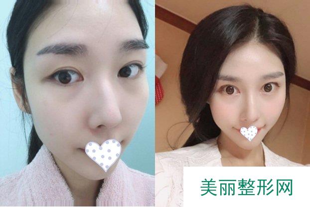 湘雅三医院美容整形科双眼皮案例图