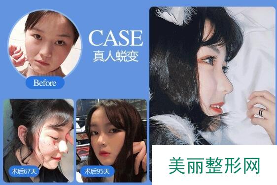 湘雅二医院整形美容科技术好不好 案例图