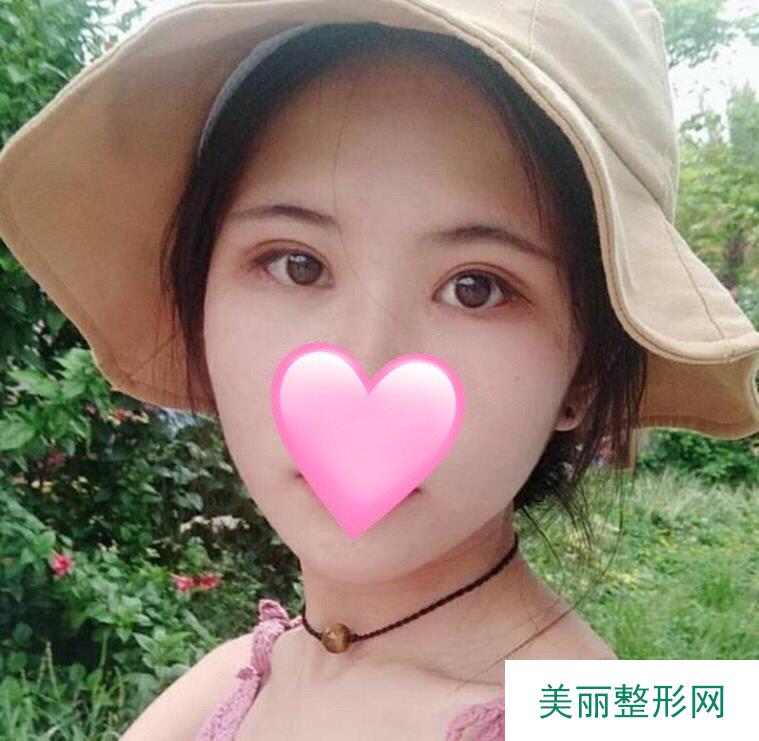 西南医院美容整形科割双眼皮价格 果图