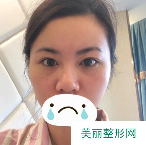 南宁区医院美容整形中心隆鼻怎么样 评价 口碑
