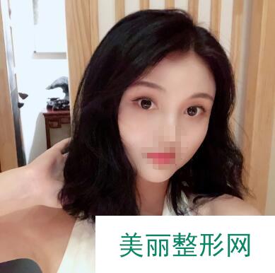 石家庄市第一医院整形美容科双眼皮果图