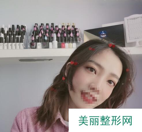 珠海人民医院整形外科割双眼皮多少钱 果图