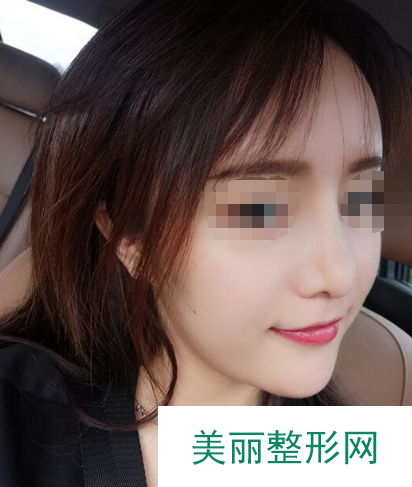 隆鼻修复案例