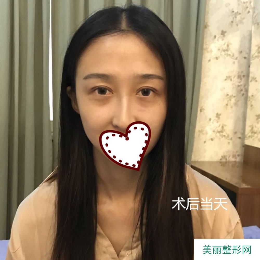 双眼皮