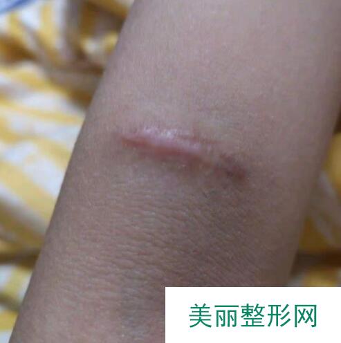 疤痕修复