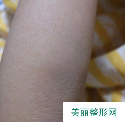 疤痕修复