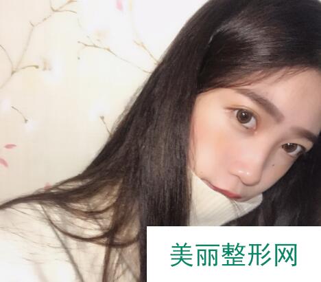 双眼皮