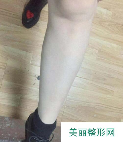 激光除毛案例