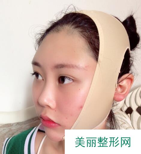 面部吸脂