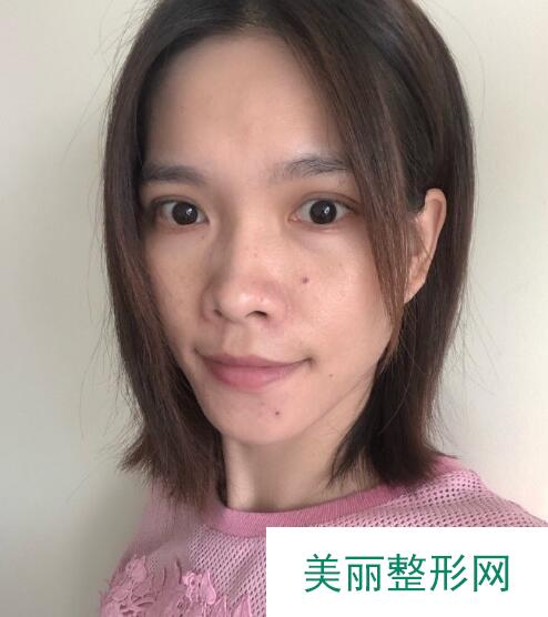 光子嫩肤