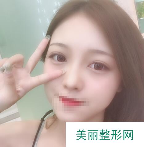 全切双眼皮