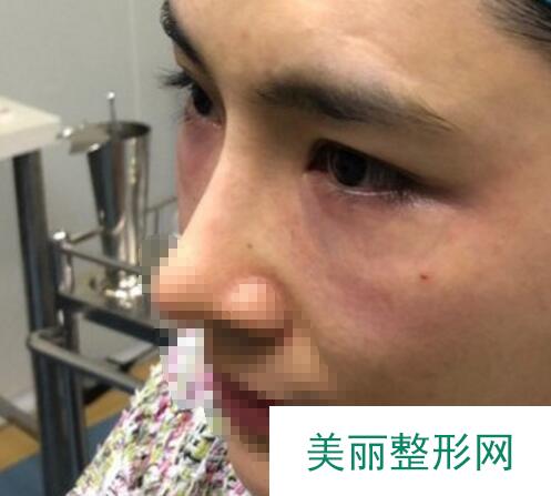 激光去眼袋