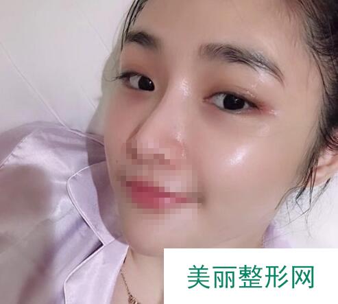 激光去眼袋