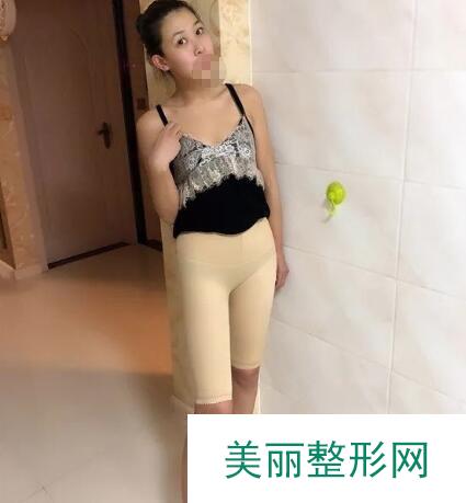 大腿吸脂