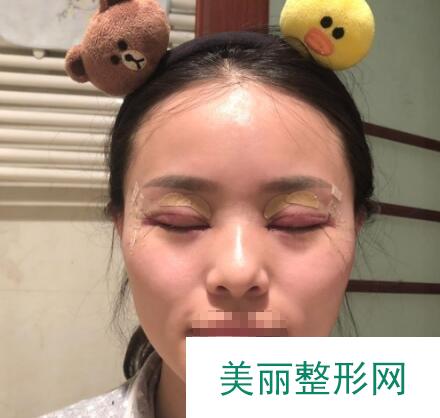 全切双眼皮
