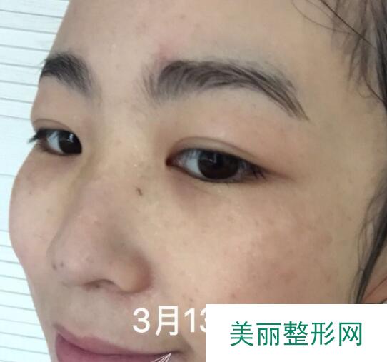 湘雅附二激光美容科祛斑案例