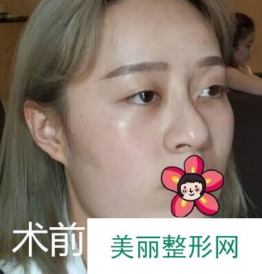 韦敏下颌角磨骨