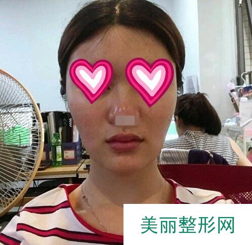 假体隆鼻