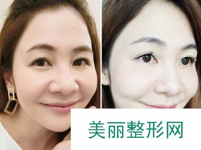 除皱提升案例