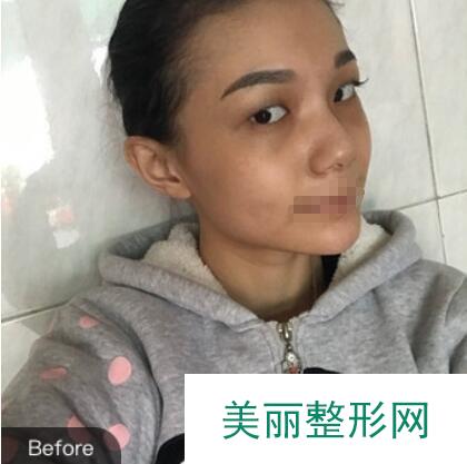 双眼皮案例