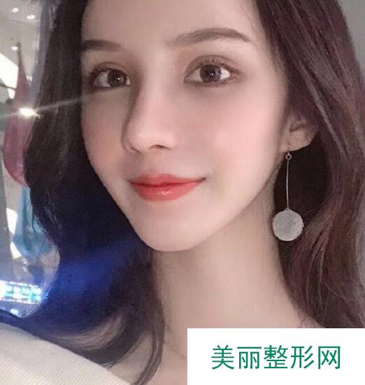 杜太超隆鼻案例