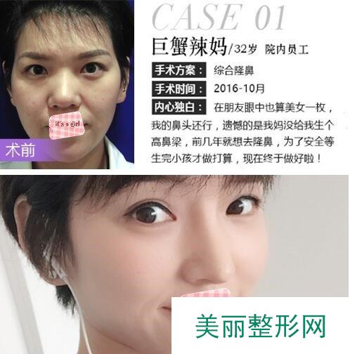 深圳米兰柏羽鼻部手术案例