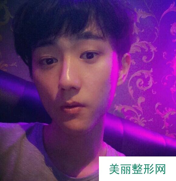 北医三院整形美容科自体填充案例
