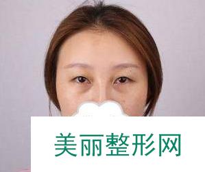 泰安中心医院整形科做双眼皮吗？