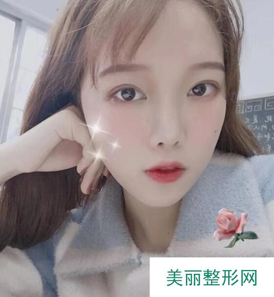 双眼皮手术案例：