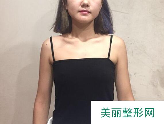 隆胸手术对比图