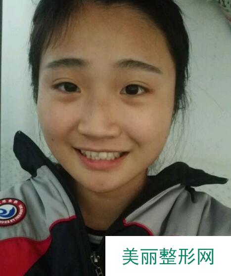 成都华西医院口腔外科牙齿矫正案例