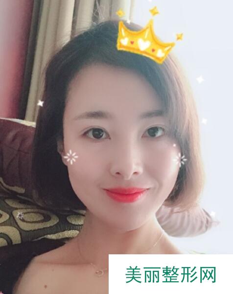 双眼皮手术反馈