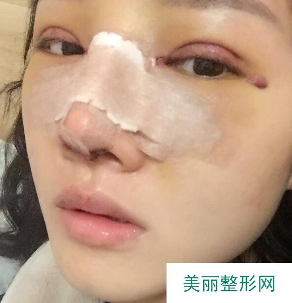 隆鼻手术对比