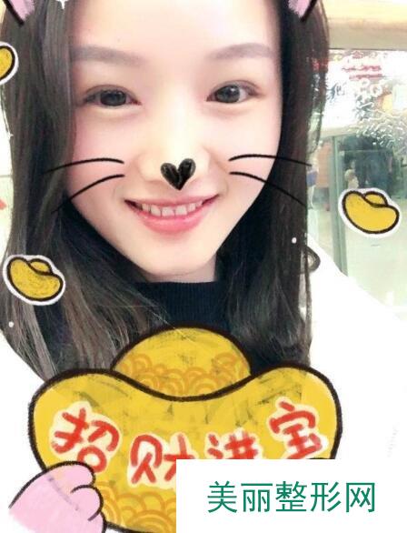 隆鼻手术对比