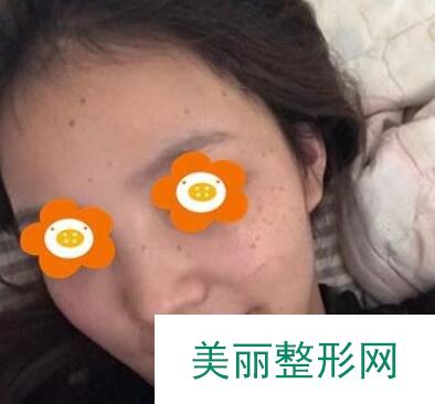 祛斑果对比